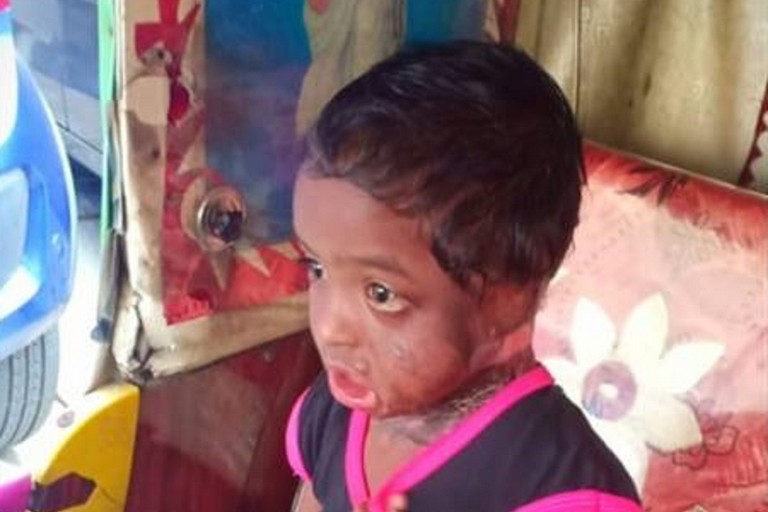 Kasi, lo sfortunato bambino indiano per il quale è stata organizzata una raccolta fondi